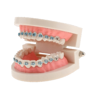 Model szczęki człowieka z aparatem ortodontycznym