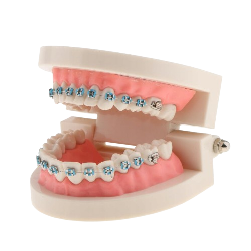 Model szczęki człowieka z aparatem ortodontycznym