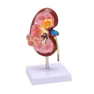 Modell der menschlichen Nierenpathologie - 3D