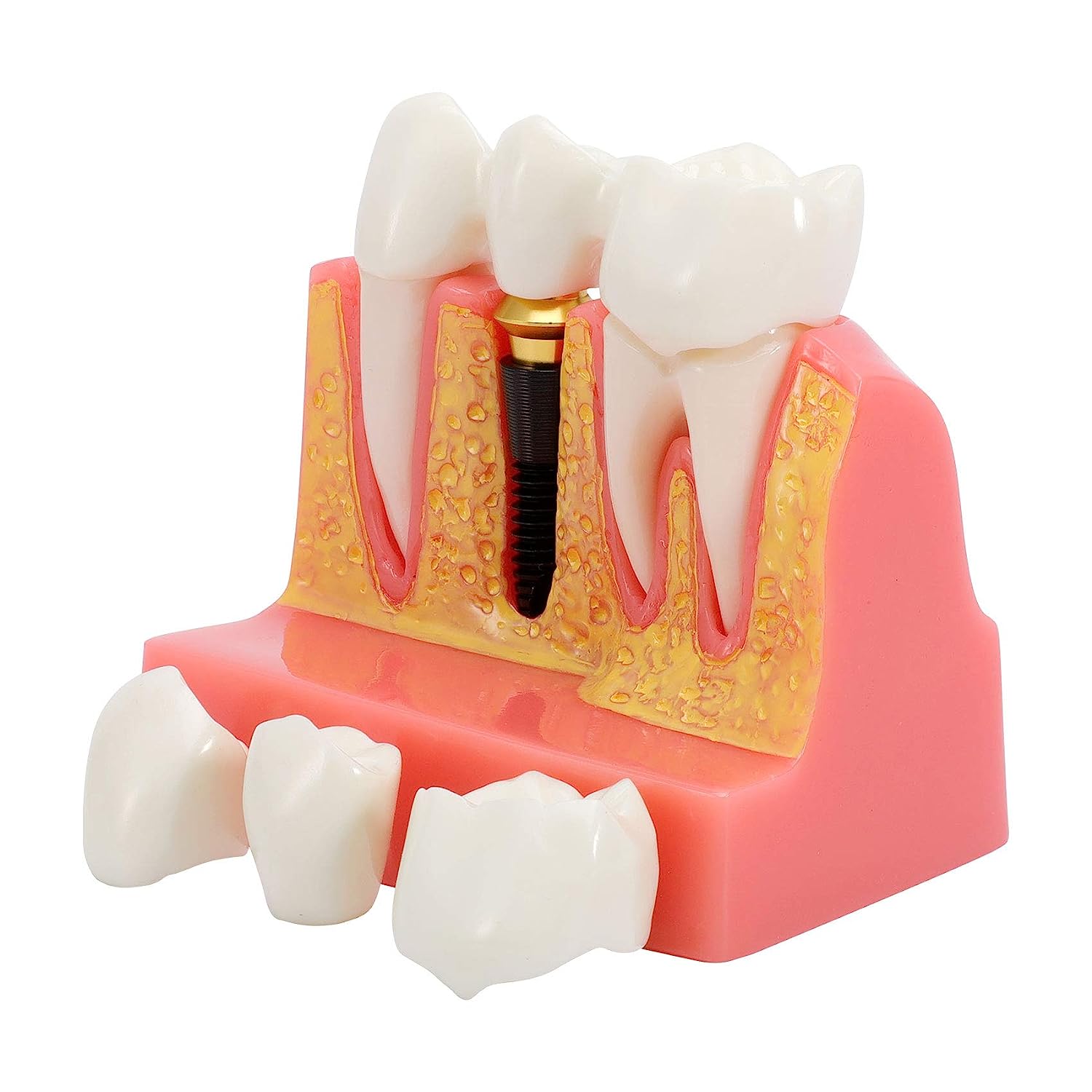 Powiększony model dziąsła z implantem
