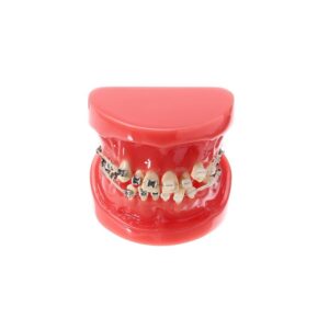 Model szczęki człowieka z wadą zgryzu