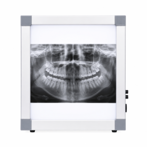 Panoramic dental X-ray displayed on a lightbox radiography viewer